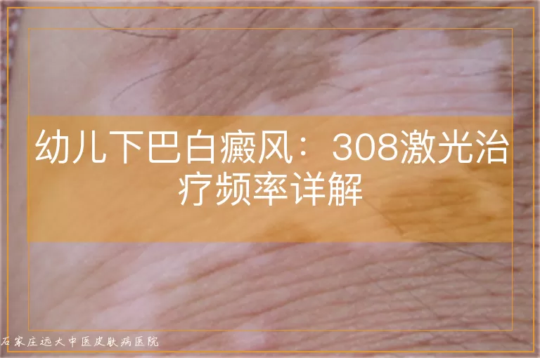 幼儿下巴白癜风：308激光治疗频率详解
