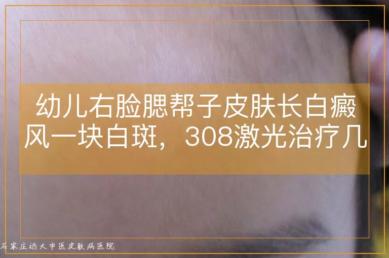 幼儿右脸腮帮子皮肤长白癜风一块白斑，308激光治疗几次能见效？