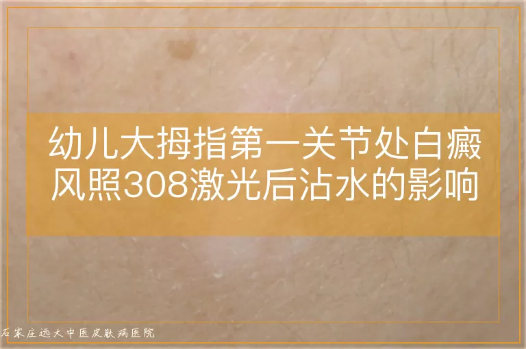 幼儿大拇指第一关节处白癜风照308激光后沾水的影响