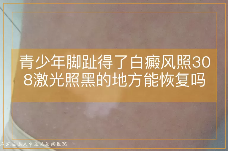 青少年脚趾得了白癜风照308激光照黑的地方能恢复吗