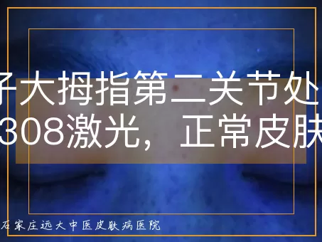 孩子大拇指第二关节处白癜风照308激光，正常皮肤会受影响吗？