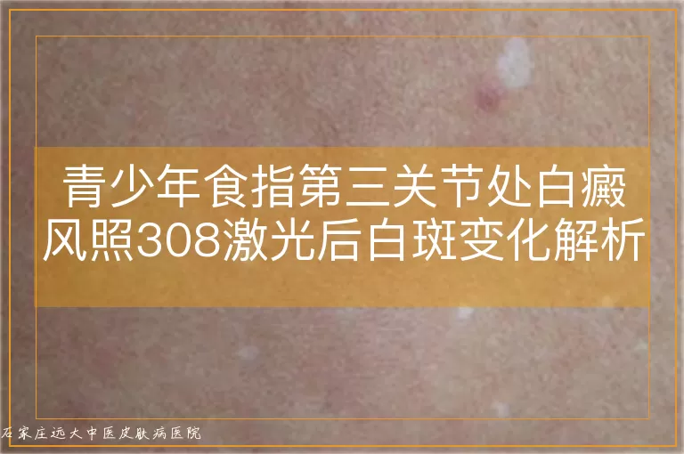 青少年食指第三关节处白癜风照308激光后白斑变化解析