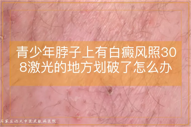青少年脖子上有白癜风照308激光的地方划破了怎么办