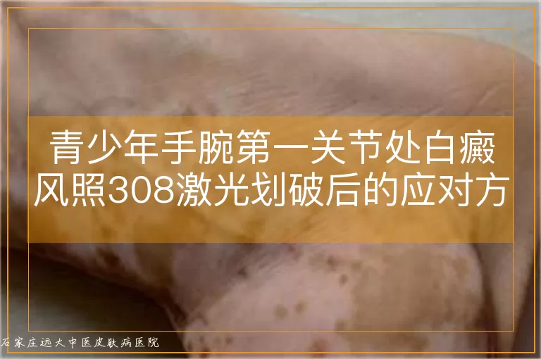 青少年手腕第一关节处白癜风照308激光划破后的应对方法