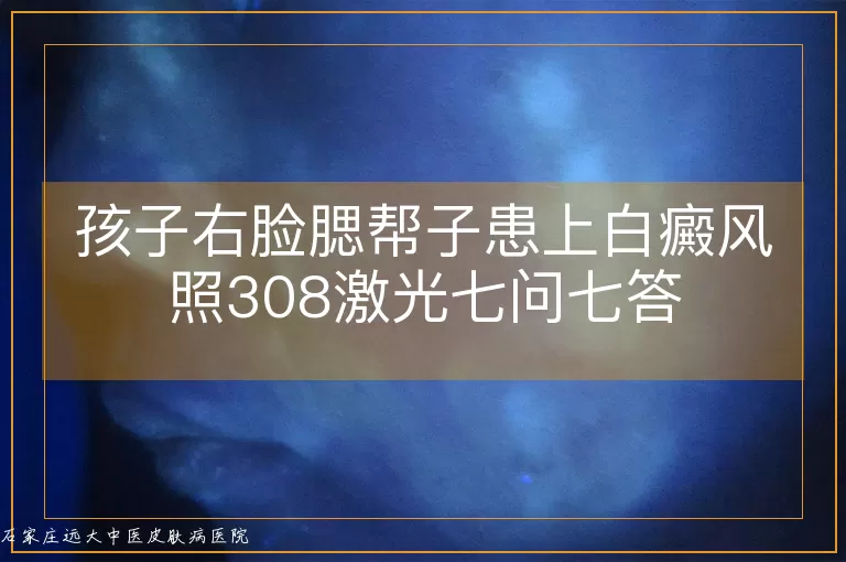 孩子右脸腮帮子患上白癜风照308激光七问七答