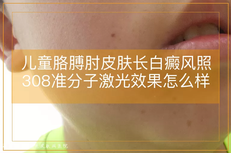 儿童胳膊肘皮肤长白癜风照308准分子激光效果怎么样