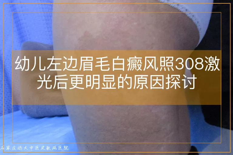 幼儿左边眉毛白癜风照308激光后更明显的原因探讨