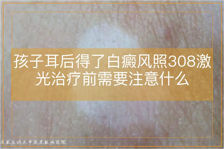 孩子耳后得了白癜风照308激光治疗前需要注意什么