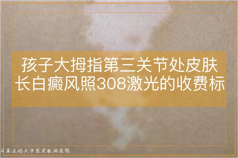 孩子大拇指第三关节处皮肤长白癜风照308激光的收费标准