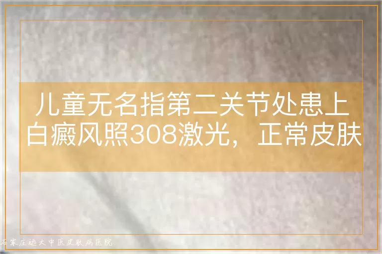 儿童无名指第二关节处患上白癜风照308激光，正常皮肤会有影响吗？