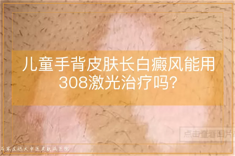 儿童手背皮肤长白癜风能用308激光治疗吗?