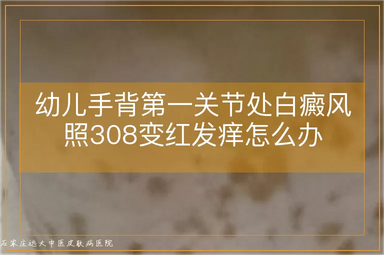 幼儿手背第一关节处白癜风照308变红发痒怎么办