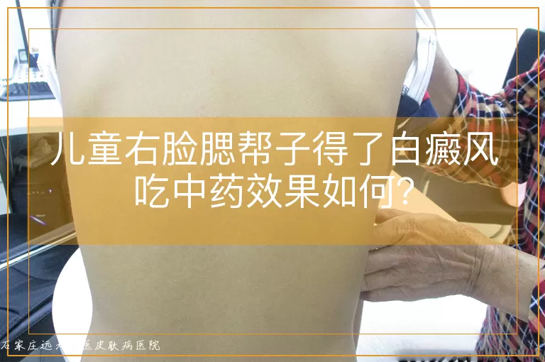 儿童右脸腮帮子得了白癜风吃中药效果如何？