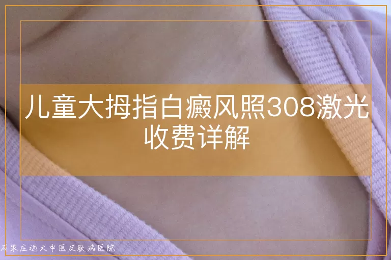 儿童大拇指白癜风照308激光收费详解