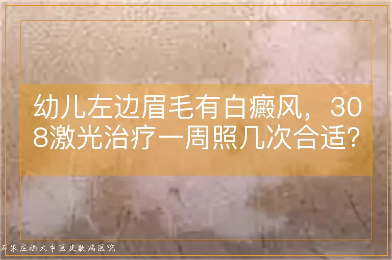 幼儿左边眉毛有白癜风，308激光治疗一周照几次合适？