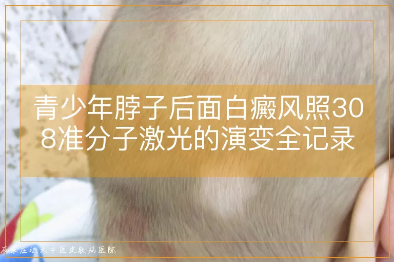 青少年脖子后面白癜风照308准分子激光的演变全记录