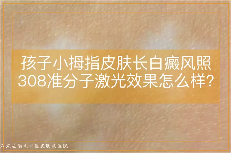 孩子小拇指皮肤长白癜风照308准分子激光效果怎么样？