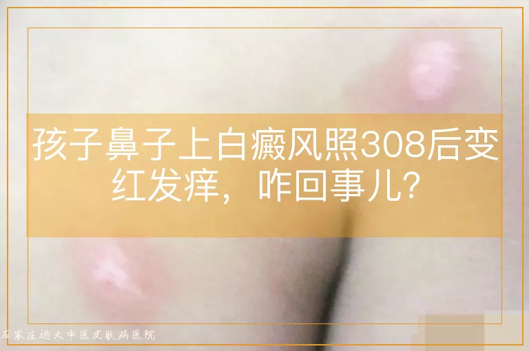 孩子鼻子上白癜风照308后变红发痒，咋回事儿？