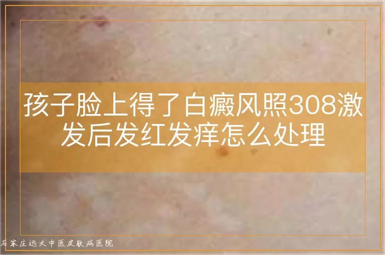 孩子脸上得了白癜风照308激发后发红发痒怎么处理