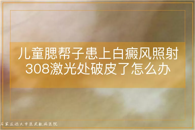 儿童腮帮子患上白癜风照射308激光处破皮了怎么办