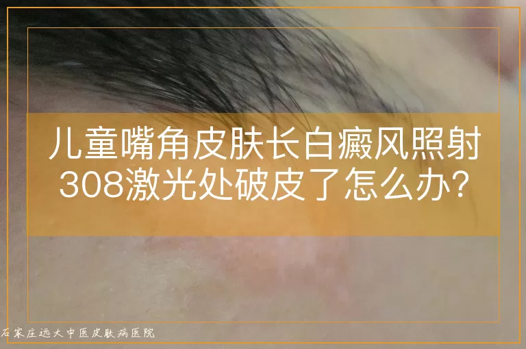 儿童嘴角皮肤长白癜风照射308激光处破皮了怎么办？