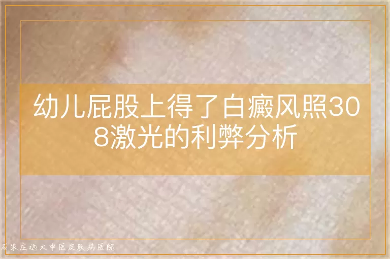 幼儿屁股上得了白癜风照308激光的利弊分析