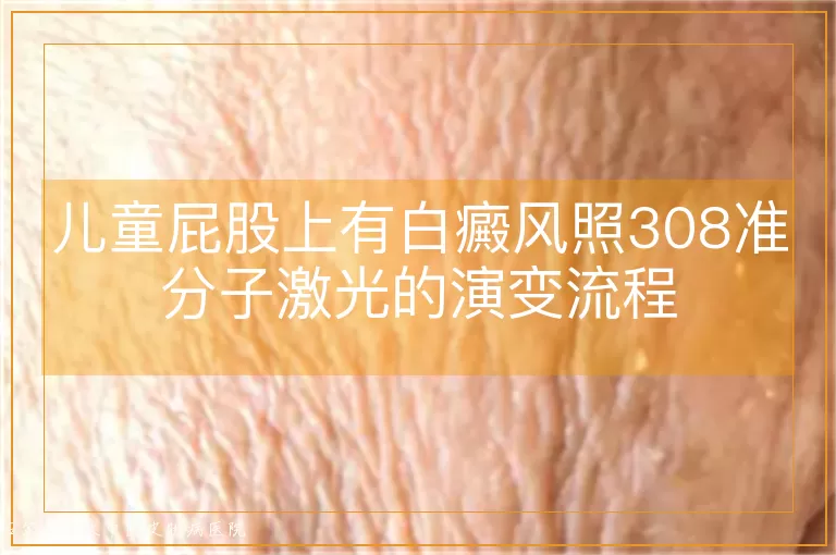 儿童屁股上有白癜风照308准分子激光的演变流程
