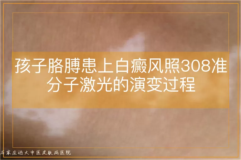 孩子胳膊患上白癜风照308准分子激光的演变过程