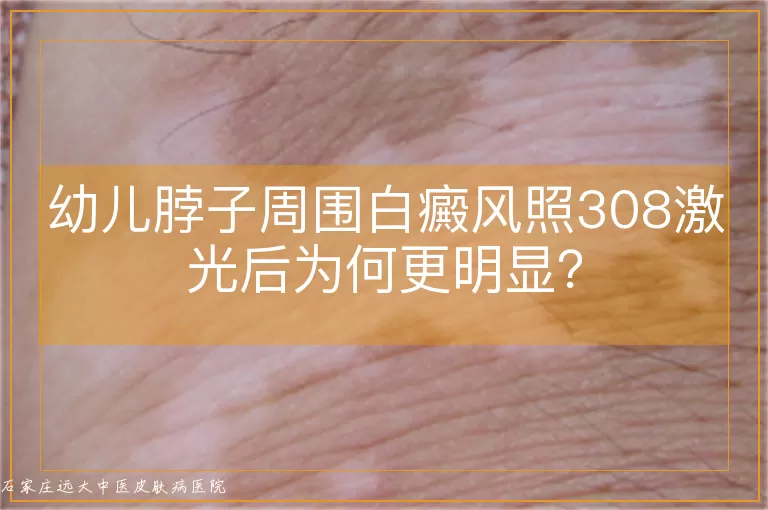 幼儿脖子周围白癜风照308激光后为何更明显？