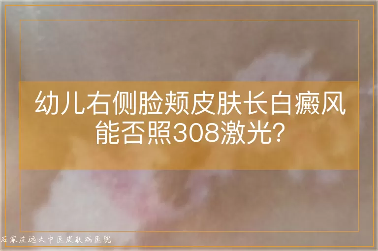 幼儿右侧脸颊皮肤长白癜风能否照308激光？