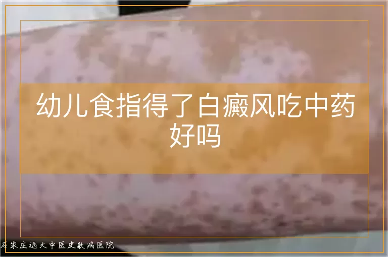 幼儿食指得了白癜风吃中药好吗
