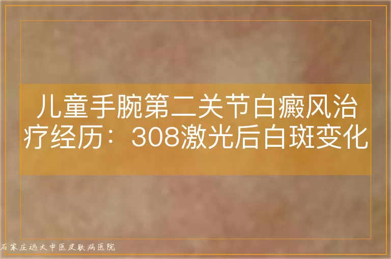 儿童手腕第二关节白癜风治疗经历：308激光后白斑变化探讨