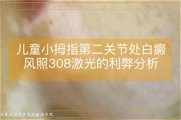儿童小拇指第二关节处白癜风照308激光的利弊分析