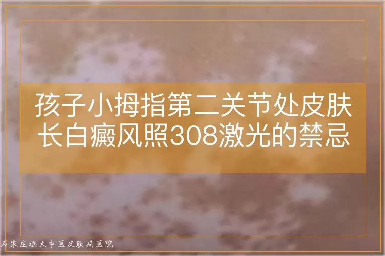 孩子小拇指第二关节处皮肤长白癜风照308激光的禁忌