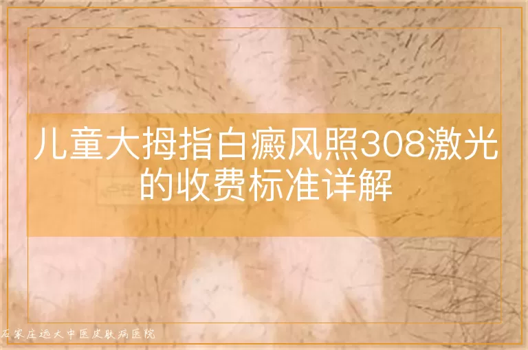 儿童大拇指白癜风照308激光的收费标准详解