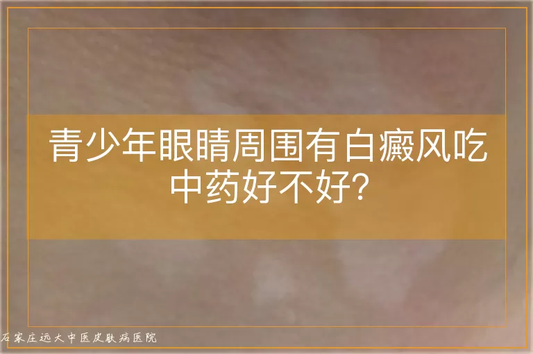 青少年眼睛周围有白癜风吃中药好不好？