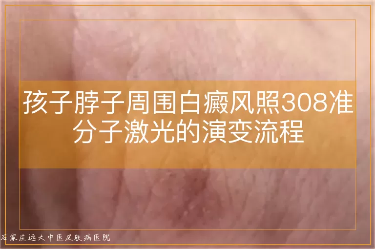 孩子脖子周围白癜风照308准分子激光的演变流程