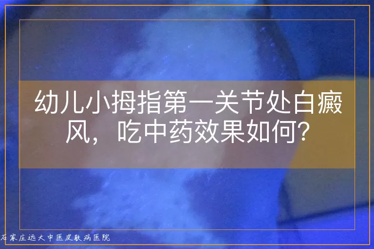 幼儿小拇指第一关节处白癜风，吃中药效果如何？