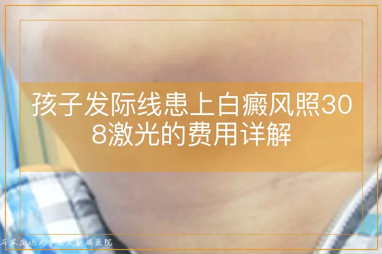 孩子发际线患上白癜风照308激光的费用详解
