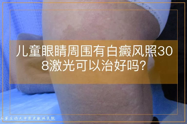 儿童眼睛周围有白癜风照308激光可以治好吗？