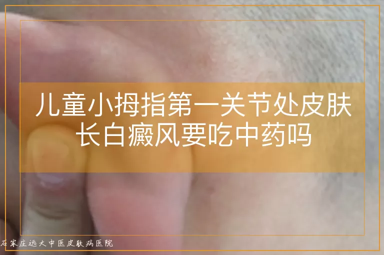 儿童小拇指第一关节处皮肤长白癜风要吃中药吗