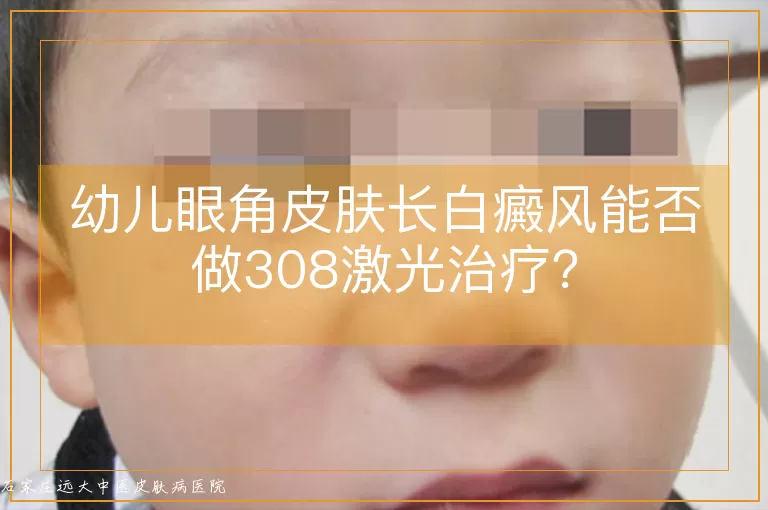 幼儿眼角皮肤长白癜风能否做308激光治疗?