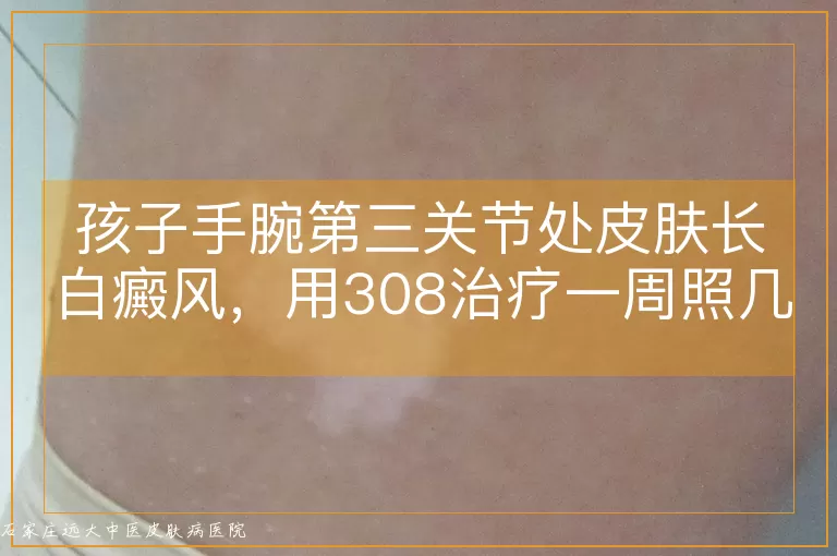 孩子手腕第三关节处皮肤长白癜风，用308治疗一周照几次最合适？