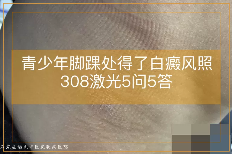 青少年脚踝处得了白癜风照308激光5问5答