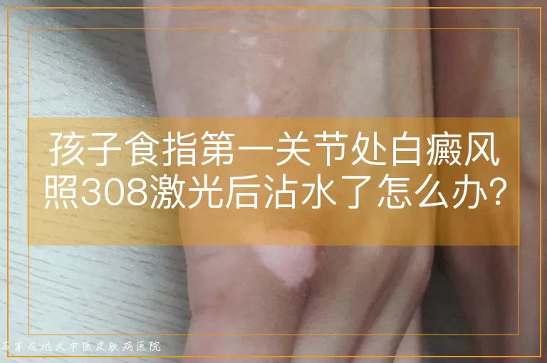 孩子食指第一关节处白癜风照308激光后沾水了怎么办?