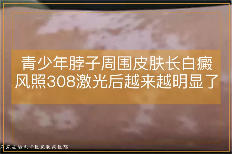 青少年脖子周围皮肤长白癜风照308激光后越来越明显了怎么回事