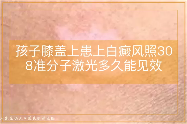 孩子膝盖上患上白癜风照308准分子激光多久能见效
