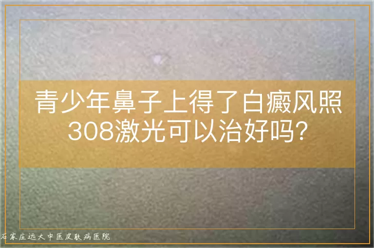 青少年鼻子上得了白癜风照308激光可以治好吗？