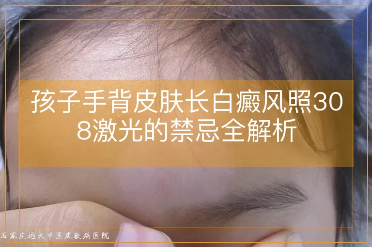 孩子手背皮肤长白癜风照308激光的禁忌全解析