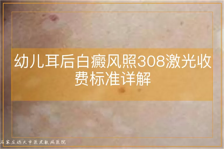 幼儿耳后白癜风照308激光收费标准详解